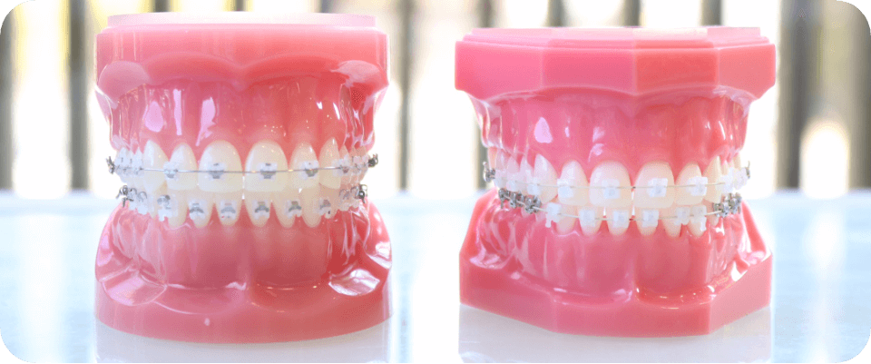 ワイヤー矯正とは？